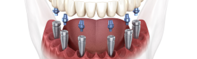 Refaire Ses Dents Exemples D Taill S Prix