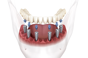 refaire ses dents avec prothèse dentaire sur implant
