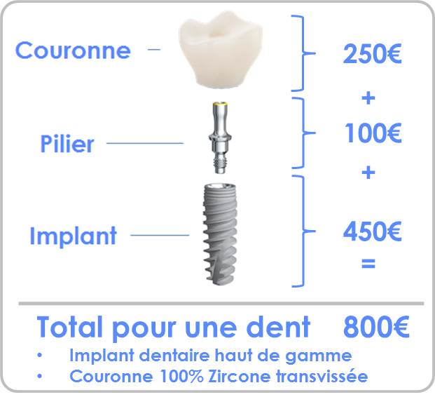 Prix implant dentaire complet