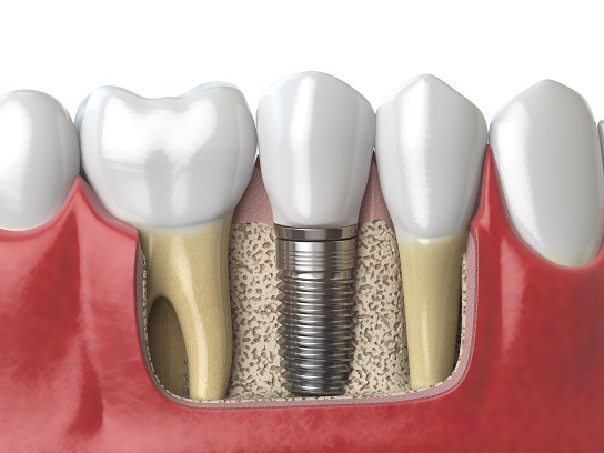 Prothèse dentaire, Bridge, Couronne - Guide complet et Prix - Newdentaire