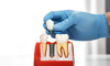 implant dentaire : que faut il savoir