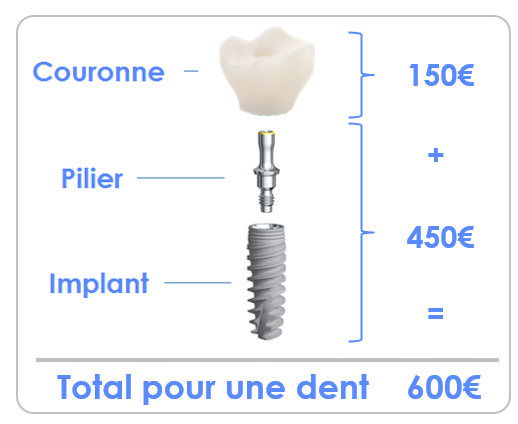 Tarif implant dentaire Bruxelles