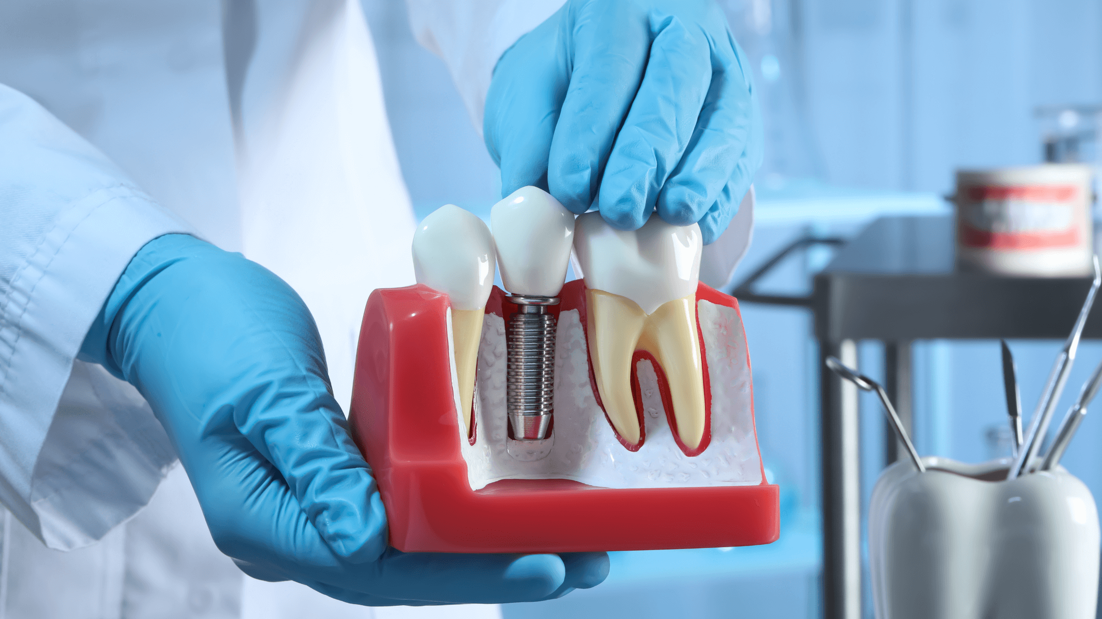 Titan vs Céramique quel implant dentaire choisir ? New Dentaire