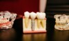Prix implant dentaire en Belgique