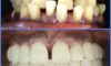 Les implants dentaires avant et après leur pose