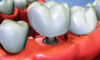L' implant dentaire basal pour se refaire les dents
