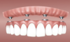 Prothèse dentaire clipsée sur implants dentaires.