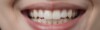 Sourire confiant avec un dentier complet confortable et naturel.