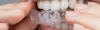 Bouche avec gouttières d’alignement transparentes sur les dents.