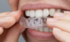 Bouche avec gouttières d’alignement transparentes sur les dents.