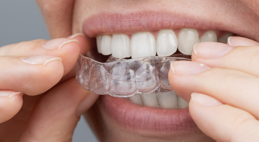 Bouche avec gouttières d’alignement transparentes sur les dents.