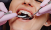 Dents avec et sans couronne dentaire.