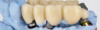 Implant dentaire ou bridge : comment décider ?