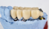 Implant dentaire ou bridge : comment décider ?
